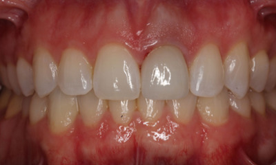 After treatment - Endo Crown