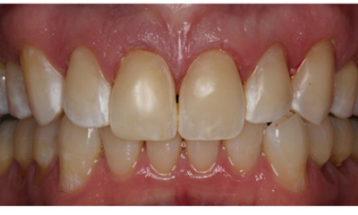 After treatment - Erosive Cervical Bonding 