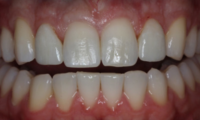 After treatment - Veneers