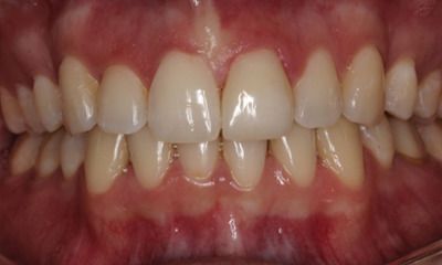 After treatment - Veneers