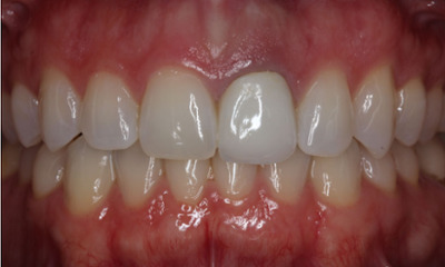 Before treatment - Endo Crown