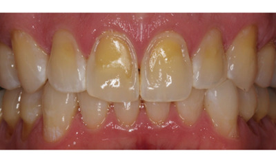Before treatment - Erosive Cervical Bonding 
