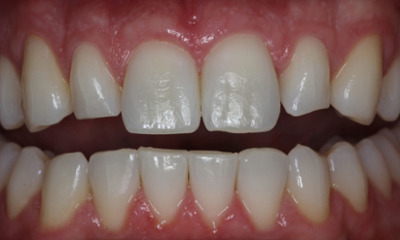 Before treatment - Veneers