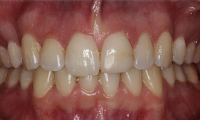 Before treatment - Veneers